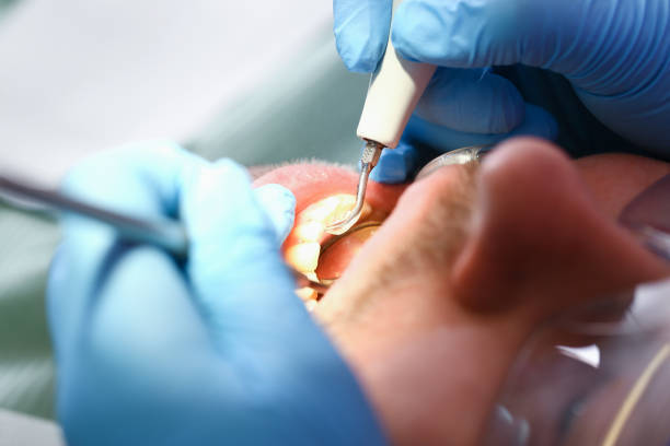 Best Emergency Wisdom Teeth Removal in Rainbow, CA